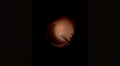 Part 1 Episode 2 Expert Insights Into Surgical Fundamentals Macular Hole Pearls