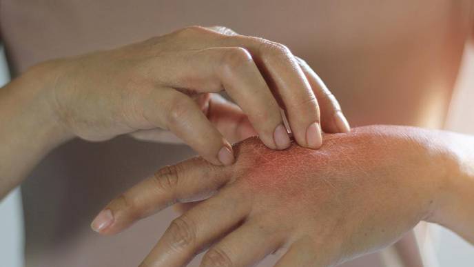 Researchers Uncover Novel Approach for Treating Eczema