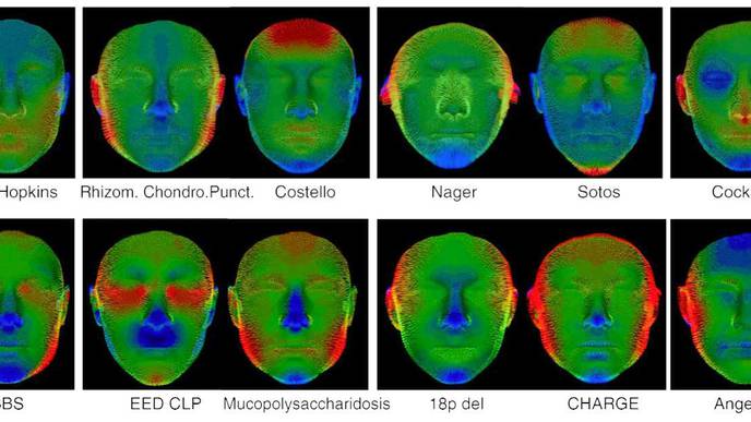 3D Facial Scans Could Speed Diagnoses for Children with Rare Genetic Diseases