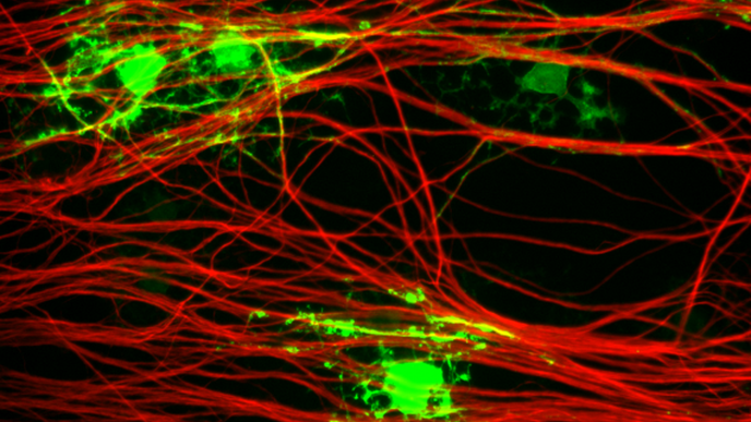 A New Approach Refining Multiple Sclerosis Genetics Hits a Nerve
