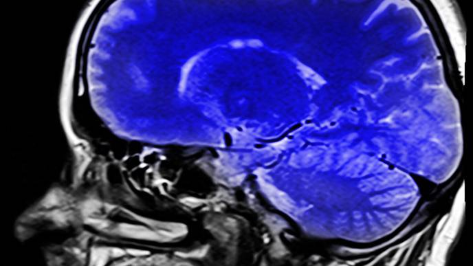 AI Models to Analyze Cancer Images Take Shortcuts That Introduce Bias