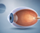 MRI Eye Shape Linked to Faster High Myopia Progression