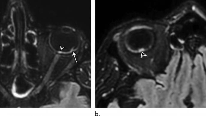 MRI Scans Link COVID-19 to Potentially Dangerous Eye Abnormalities