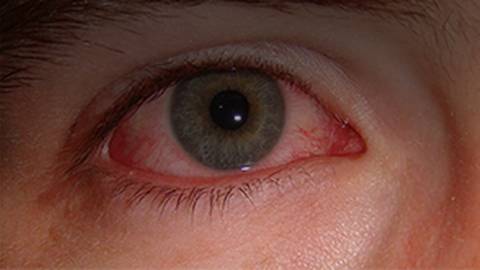 The Red Eye: Causes, Treatments, and Pitfalls for the Primary Care Physician