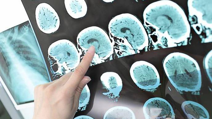 Stroke Treatment Can Have Dire Consequences When Kidney Function is Low
