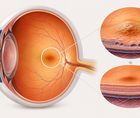 interleukin 6 inhibition with vamikibart for uveitic macular edema