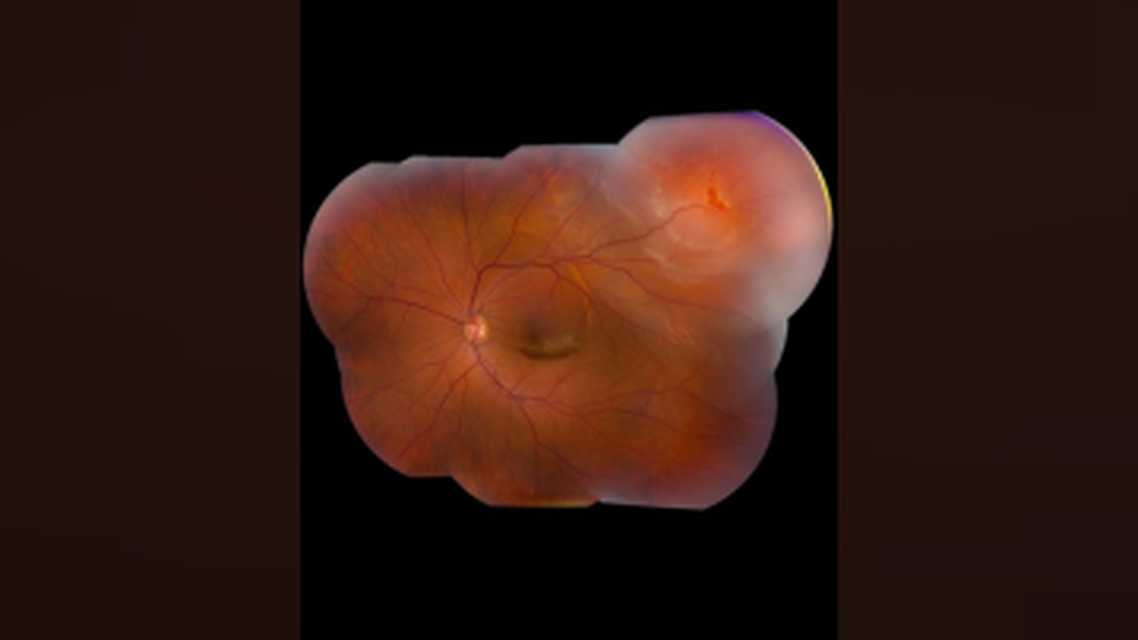 Part 1 Episode 1 Expert Insights Into Surgical Fundamentals Rhegmatogenous Retinal Detachment