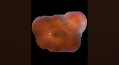 Part 1 Episode 1 Expert Insights Into Surgical Fundamentals Rhegmatogenous Retinal Detachment
