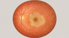 gildeuretinol acetate in geographic atrophy what the saga trial reported