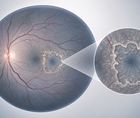 avacincaptad pegol shows two year benefit in geographic atrophy