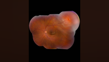 Part 1 Episode 1   Expert Insights Into Surgical Fundamentals Rhegmatogenous Retinal Detachment