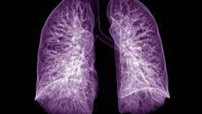 Lung Complications Noted in Half of COVID-19 Surgical Patients