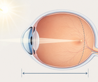 Simplified eye cross section showing axial length and pediatric myopia control