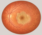 gildeuretinol acetate in geographic atrophy what the saga trial reported