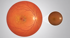 Stylized retina and macula showing age related macular degeneration lesions