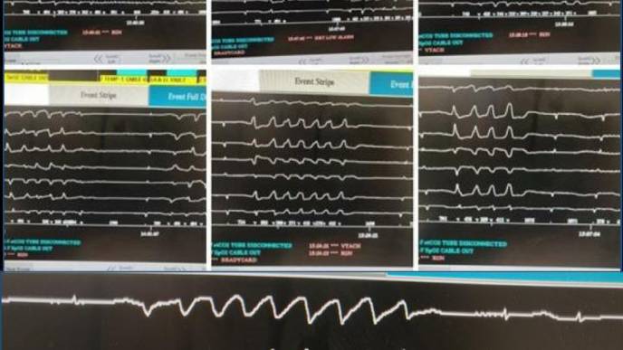 First Known Case of a Potentially Deadly Heart Rhythm Disturbance Induced by Chloroquine Therapy for COVID-19 Reported