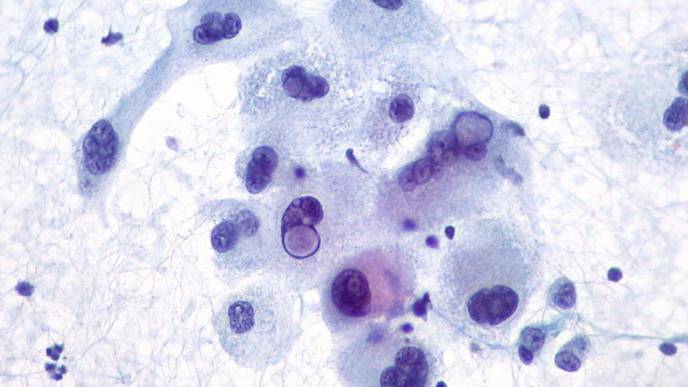 Triggering Melanoma Cell Death to Fight Cancer with Its Own 'Suicide Switch'