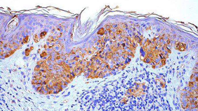 Researchers ID New Treatment Target for Melanoma