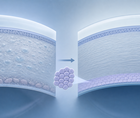 escalon trial tests corneal endothelial cell therapy for corneal edema