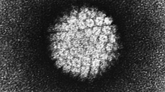 HPV Might Cause 1 in 5 Cases of Prostate Cancer, Analysis Says