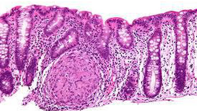 IBD Linked to Doubling in Dementia Risk