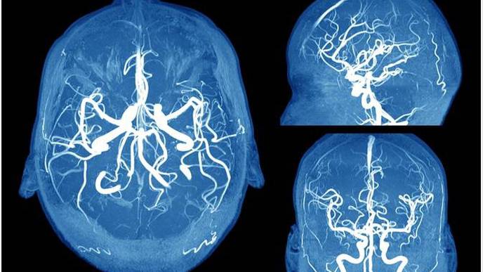 Why Are Women More Likely to Have Brain Aneurysms Compared to Men?