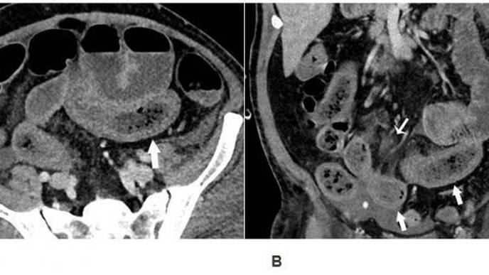 Imaging Reveals Bowel Abnormalities in Patients with COVID-19