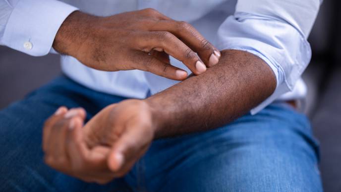 Research Uncovers Connections Between Psoriasis & Joint Disease