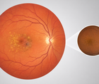 Stylized retina and macula showing age related macular degeneration lesions