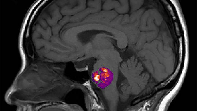 Study Ties Stroke-Related Brain Blood Vessel Abnormality to Gut Bacteria
